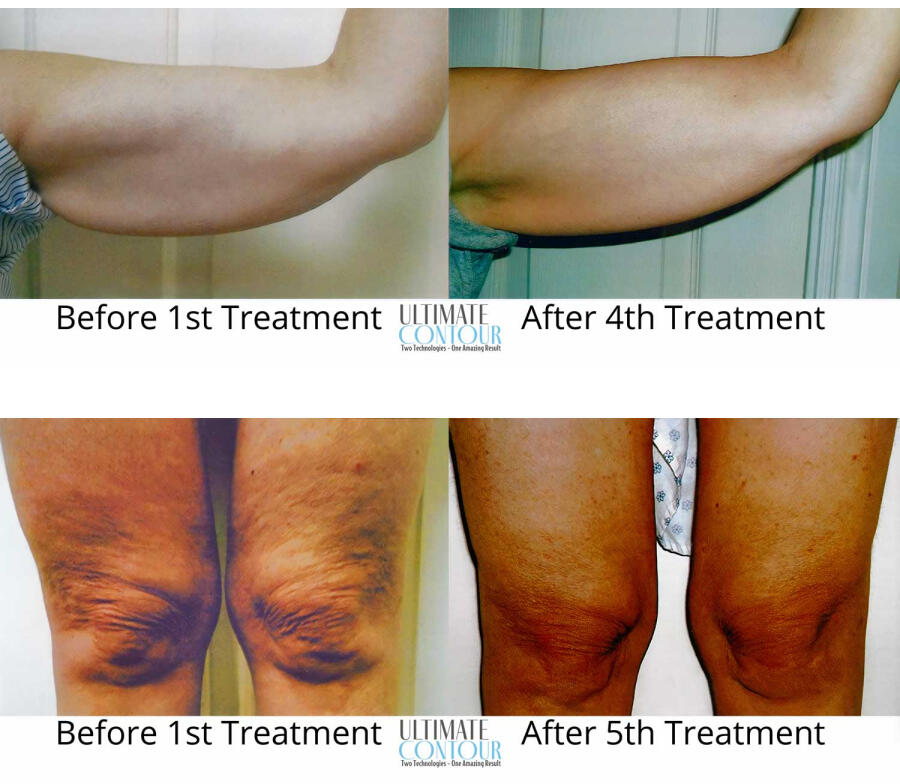 A series of photos showing the progress of body contouring treatments. The top left photo shows the person's arm before the first treatment, with noticeable fullness. The top right shows the arm after the fourth treatment, with a visible reduction in ful