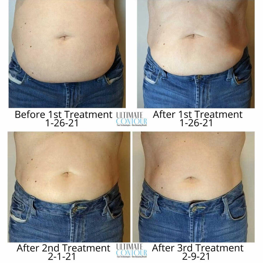 A series of four photos showing the progress of body contouring treatments. The top left shows the person's abdomen before the first treatment on 1-26-21, with noticeable bulging and skin folds. The top right shows the abdomen after the first treatment o