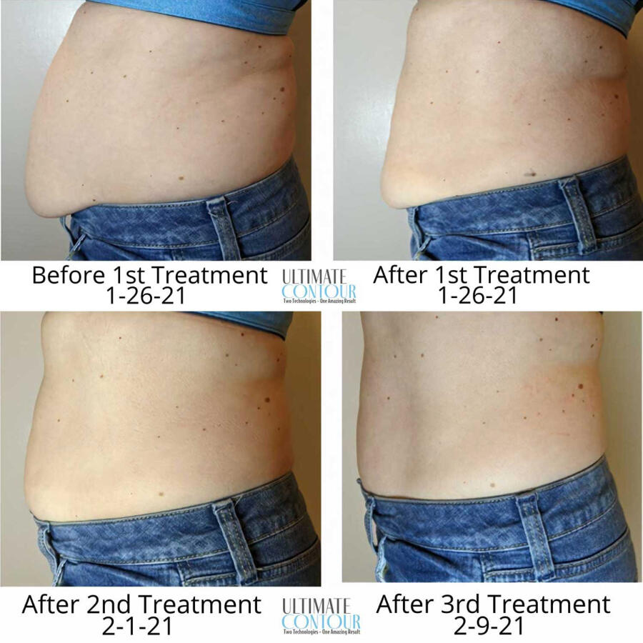 A series of four photos showing the progress of a body contouring treatment. The top left shows the person's abdomen before the first treatment on 1-26-21, with a slight bulge. The top right shows the abdomen after the first treatment on 1-26-21, with visi
