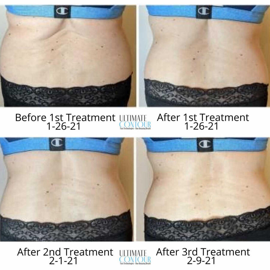 A series of four photos showing the progress of body contouring treatments. The top left shows the person's abdomen before the first treatment on 1-26-21, with visible bulging and uneven skin. The top right shows the abdomen after the first treatment on
